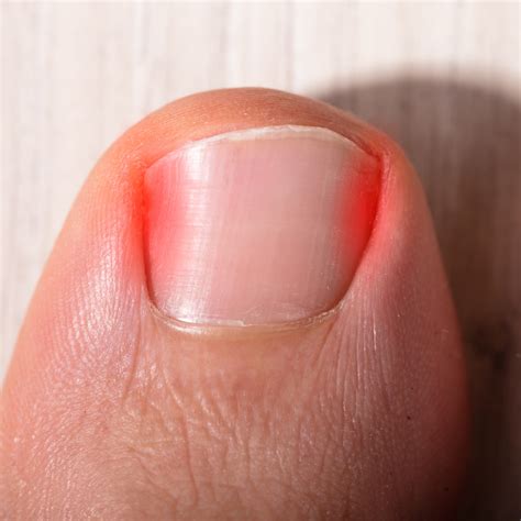 The Significance of Properly Maintaining Your Toenails for Restful Sleep