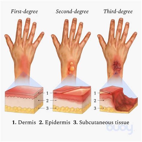 The Significance of the Affected Body Part in Burn Dreams