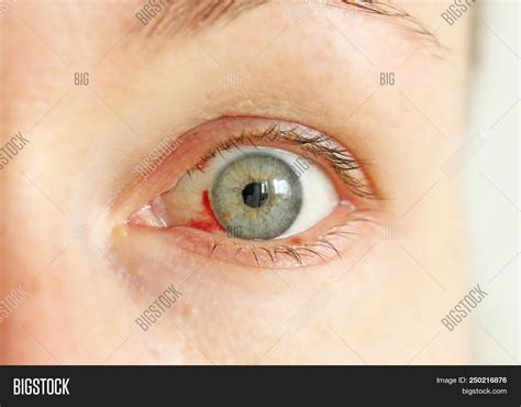 The Uncanny Sensation of Bloodied Eyelids