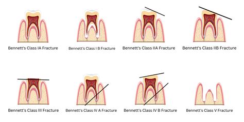 The significance of dreams involving the fracture of a prominent tooth