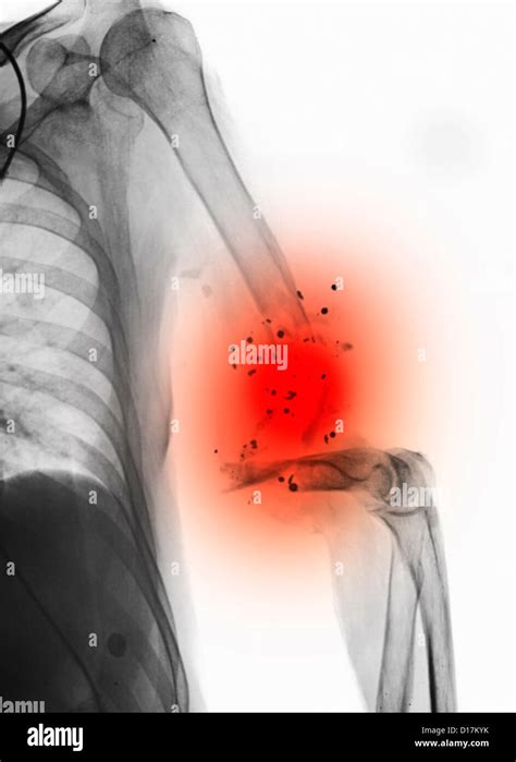 Tips for Analyzing and Deciphering Dreams of Sustaining a Gunshot Wound to the Upper Arm