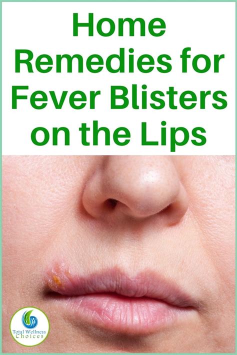 Treating Fever Blisters: Over-the-Counter and Home Remedies