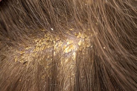Understanding the Causes of Persistent Flaky Scalp