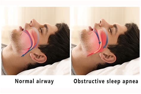 Understanding the Origins of Nasal Congestion during Sleep