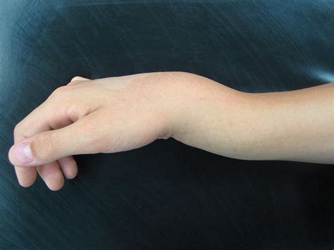 Understanding the Psychological Interpretation of Fracturing Wrist in Dreams