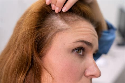Unraveling the Enigma of Hair Thinning in Females