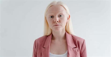 Unveiling the Hidden Connection: Insights into Albino Dreams