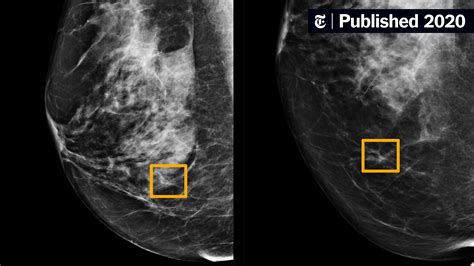 What Dreaming of Breast Tumors May Indicate: Unveiling the Significance
