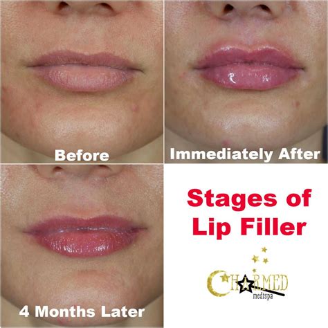 What to Expect During a Lip Injection Procedure: A Step-by-Step Guide
